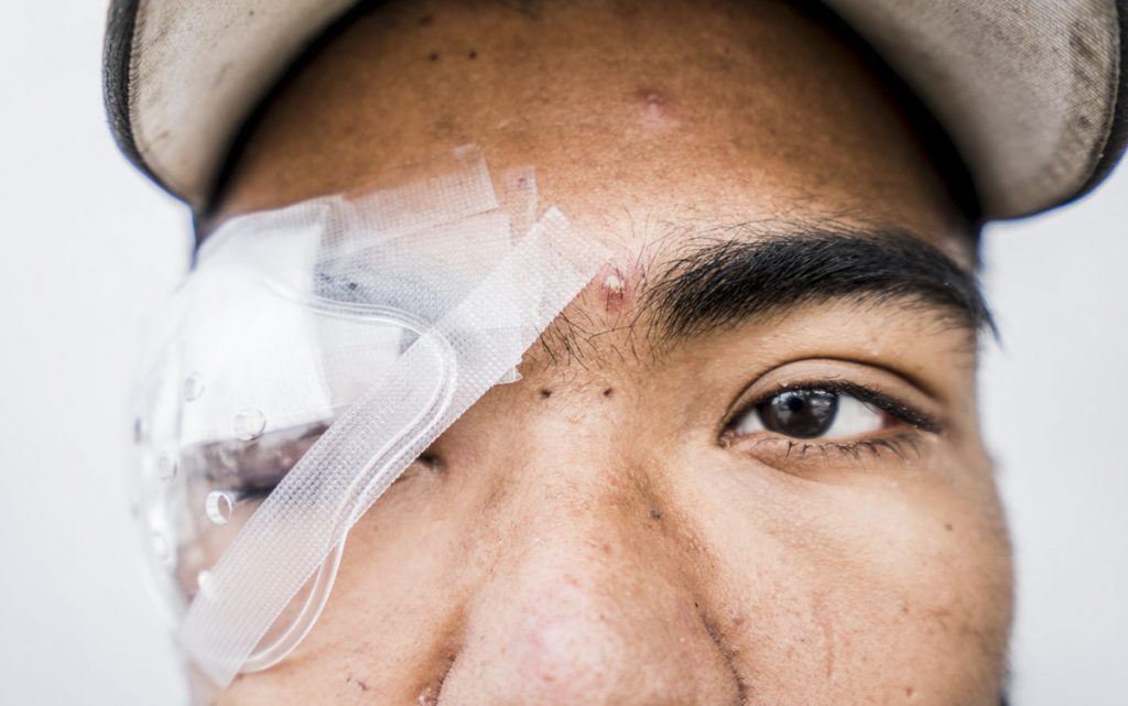 "La metáfora infame": La ceguera colectiva que buscan los dueños de Chile Hombre con vendaje en el ojo izquierdo, representando ceguera o falta de visión sobre realidades sociales
